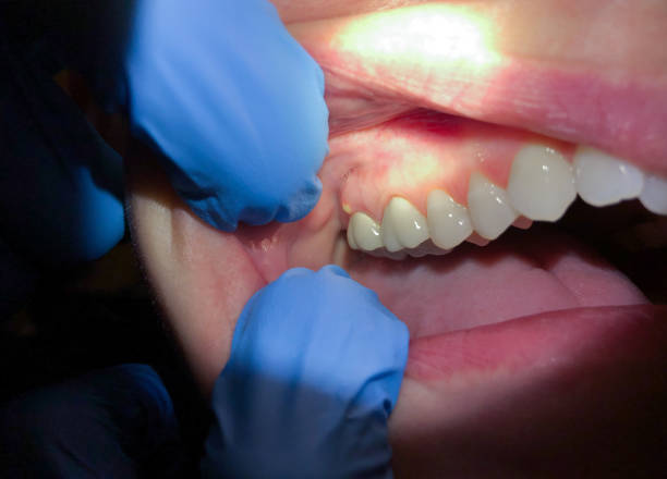 Best Chipped Tooth Repair Near Me  in Ramtown, NJ